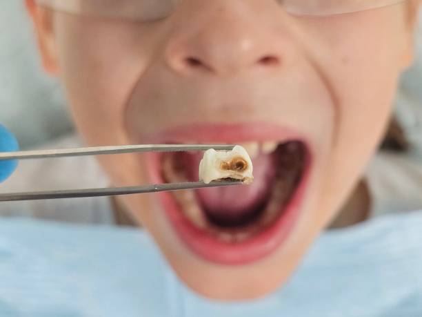 Best Emergency Tooth Extraction in Fall River, WI